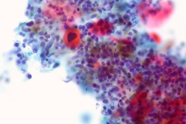 Jeûner avant le début d’une chimiothérapie pourrait améliorer l’état de malades du cancer du sein