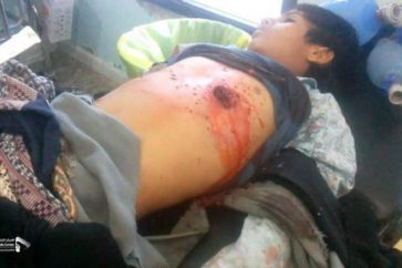 Un enfant yéménite blessé suite aux bombardements de la  coalition saoudienne