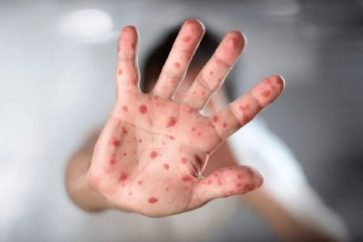 Avec 207 cas, la Grande Bretagne est la plus touchée pami les pays non endémiques