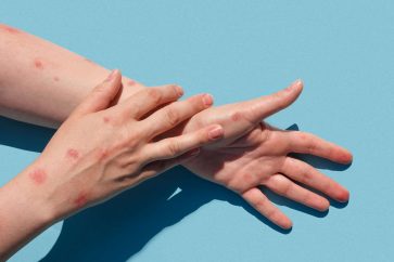 La majorité des cas recensés concerne des hommes ayant des relations sexuelles avec des hommes.