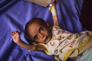 Un bébé palestinien souffrant de malnutrition due au blocus israélien contre Gaza.