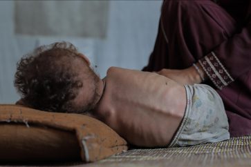 Un enfant palestinien souffrant de malnutrition en raison du blocus israélien (Illustration)