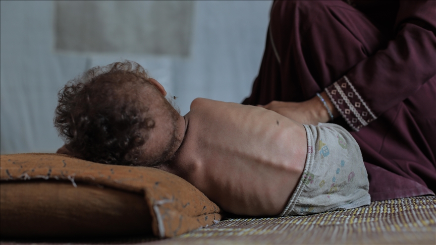 Un enfant palestinien souffrant de malnutrition en raison du blocus israélien (Illustration)